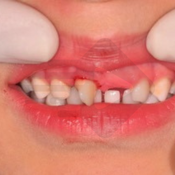 Qual a origem das bactérias em um dente traumatizado?