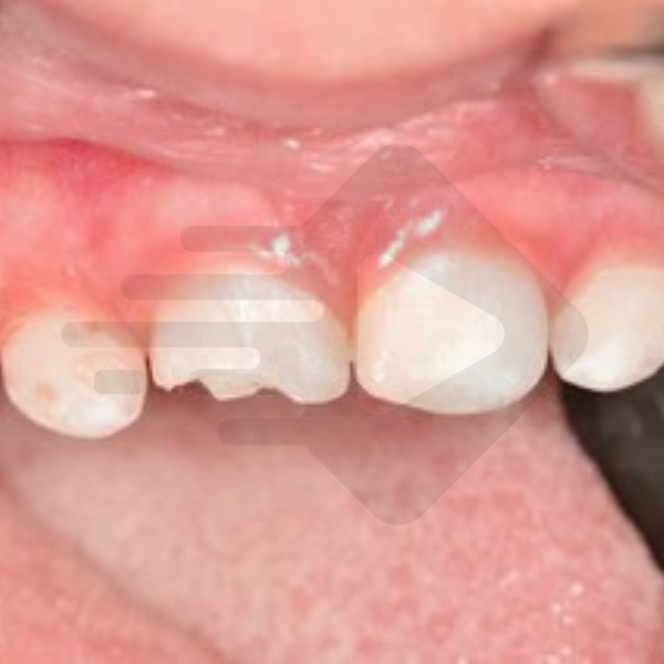 O celular quebrou meu dente? O que a literatura nos diz…