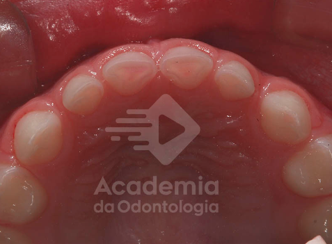 Faça o diagnóstico diferencial entre bruxismo e erosão com segurança