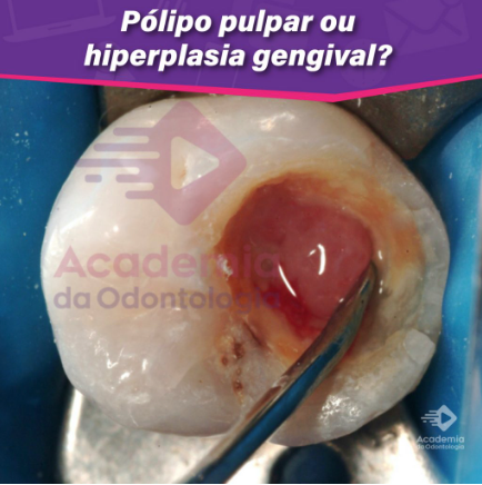 Pólipo pulpar ou hiperplasia gengival?