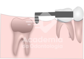Perda precoce do segundo molar decíduo