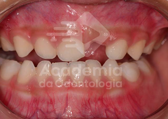 Perda precoce de incisivo decíduo, tudo que você precisa saber para escolha do mantenedor de espaço