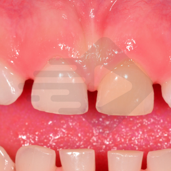 Trauma no dente decíduo: O que fazer quando o dente fica escurecido?