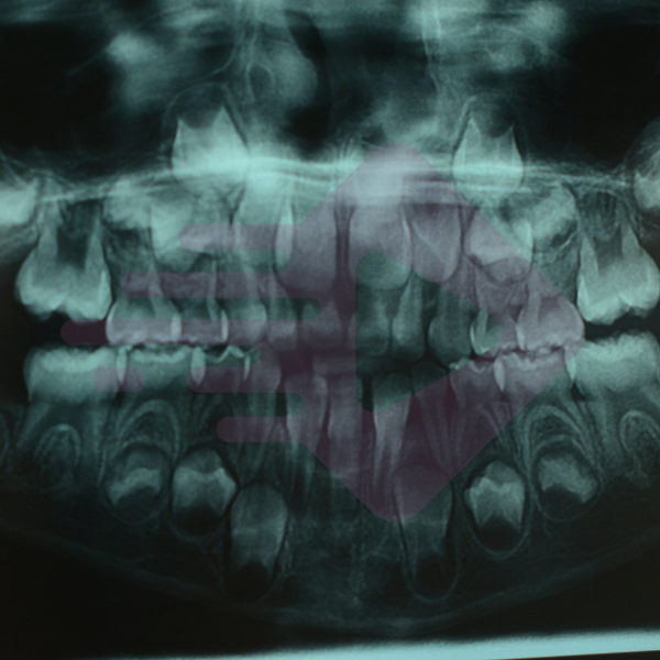 Trauma em dente decíduo: vamos acompanhar o seu sucessor permanente?