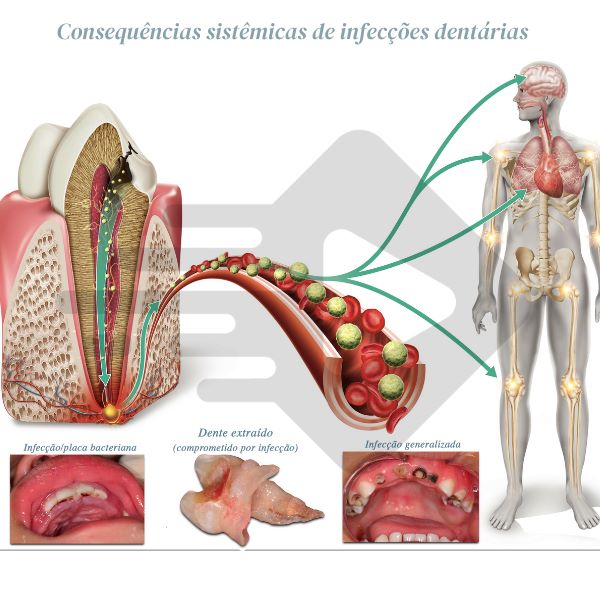 Profilaxia antibiótica em odontopediatria: quando e como prescrever?