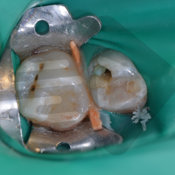 Consequências de dentes não tratados com necrose silenciosa