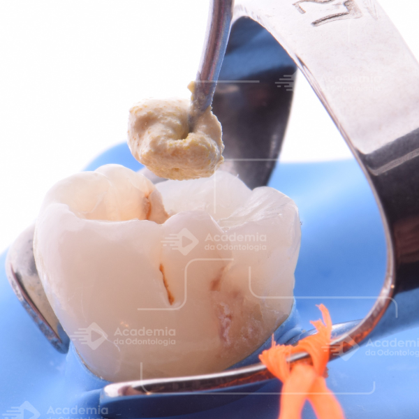 Podemos utilizar a Pasta CTZ em todos os casos de tratamento endodôntico de dentes decíduos não-vitais?