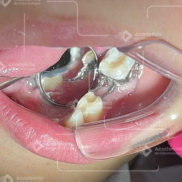 Perda Prematura de Dentes de Leite: Mantenedor de Espaço é Necessário?