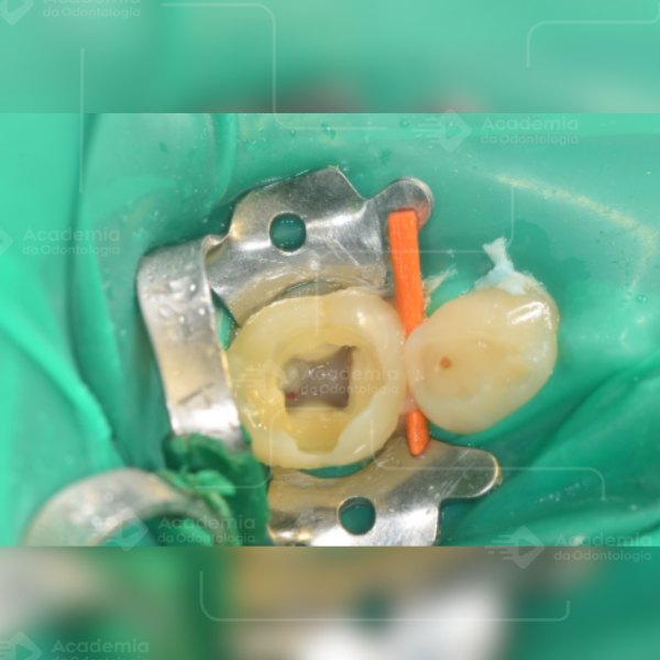 Sucesso ou insucesso para endodontia em dentes decíduos?