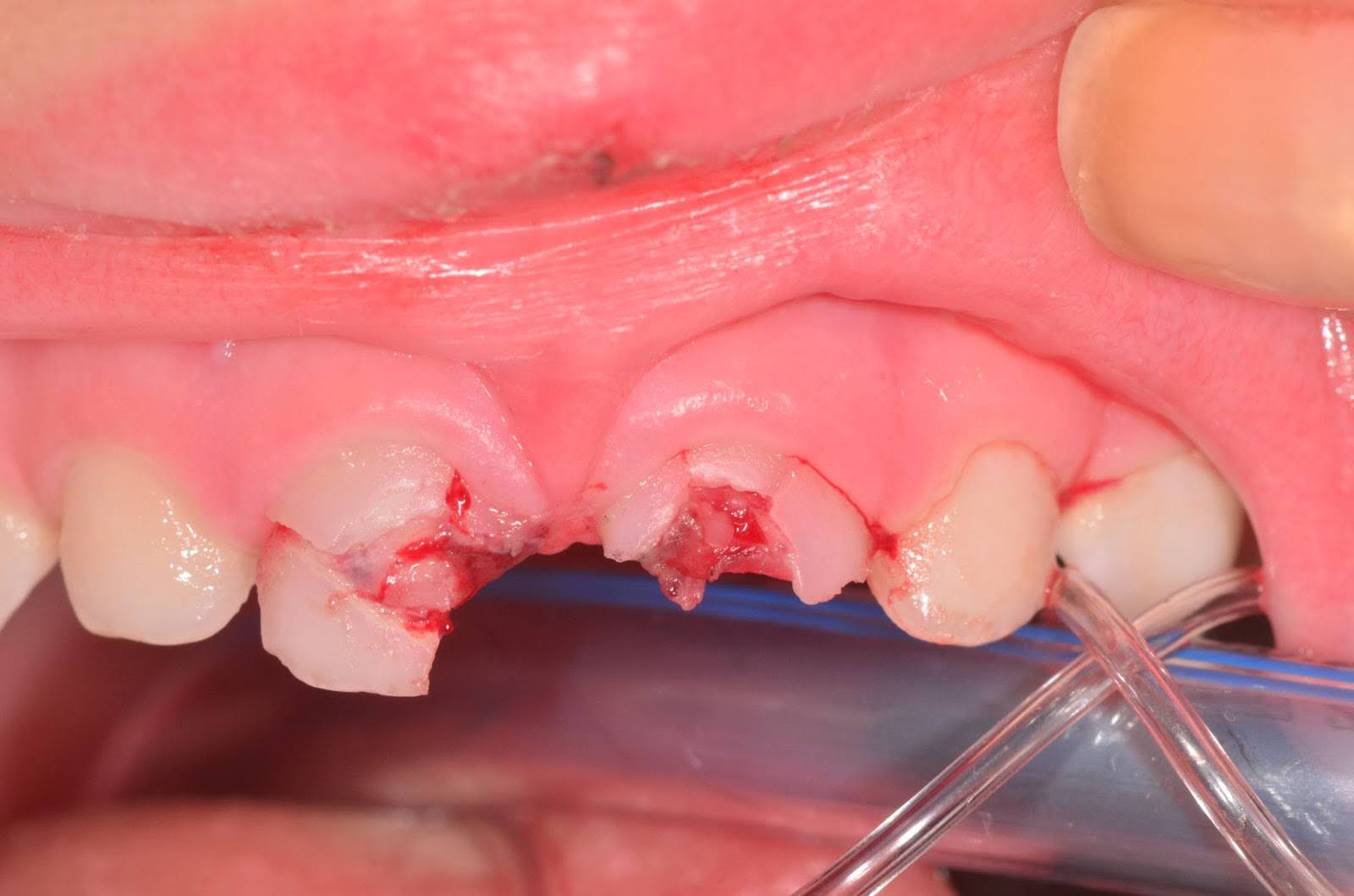 Sequelas na Dentição Permanente Após Lesão Dentária Traumática na Dentição Primária – Um Estudo de Corte Retrospectivo