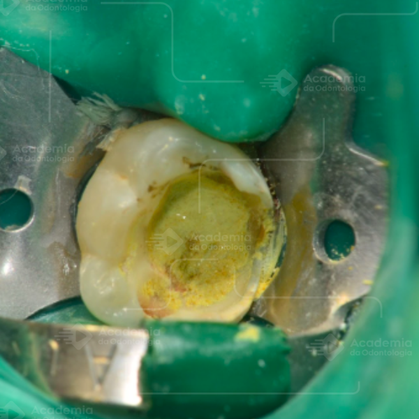 🦷 Tratamento de Molares Decíduos com Necrose Pulpar: LSTR com Pasta CTZ vs. Pulpectomia Convencional