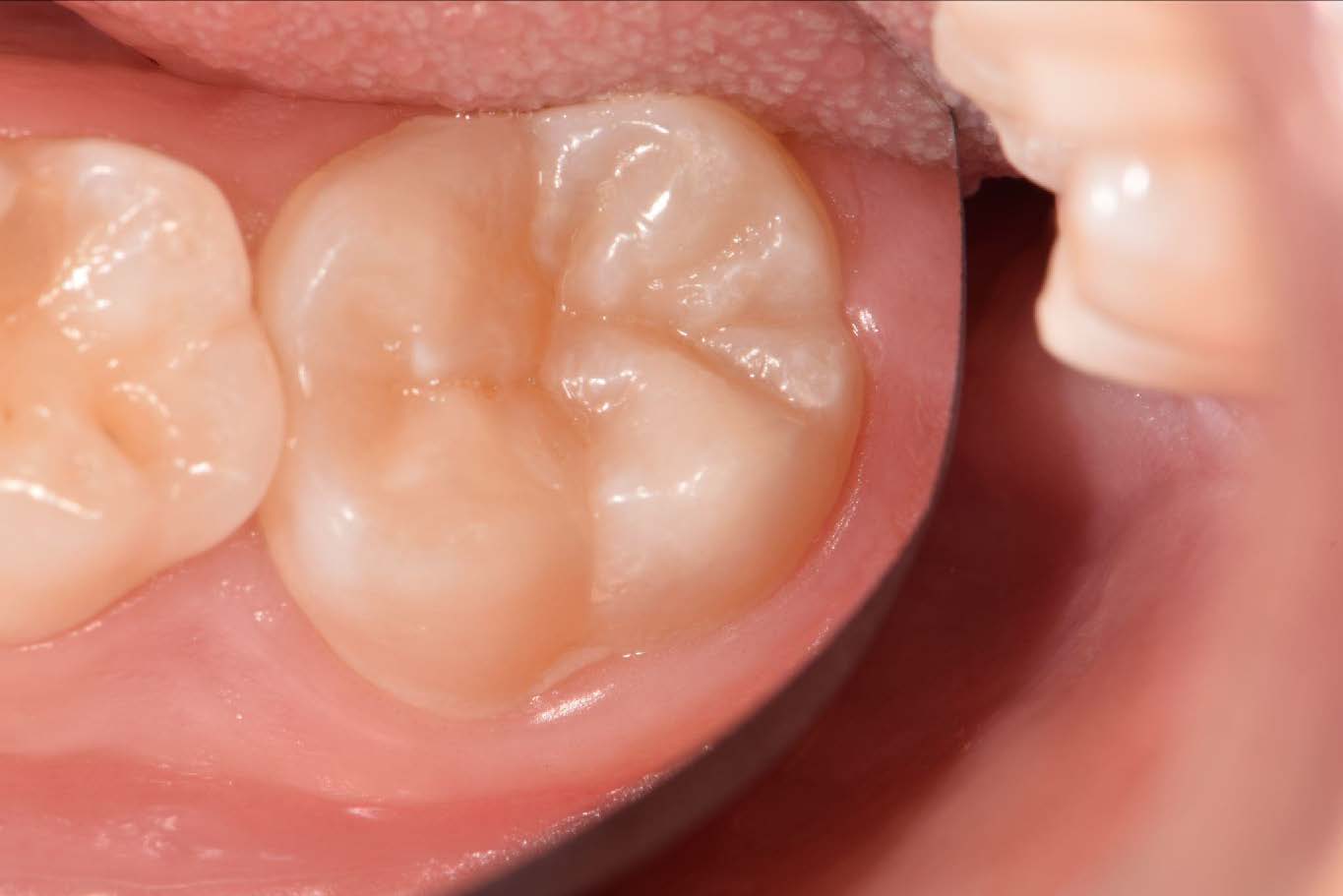 Selante Oclusal em Dentes Permanentes: Quando e Por Que Indicar?