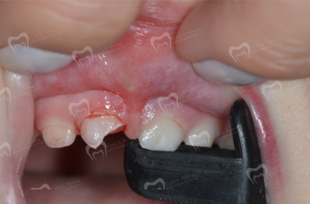 Será que smartphones são responsáveis por trauma dentário?